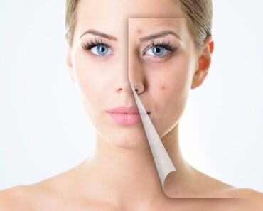 Say Goodbye to Breakouts: 9 Natural Hormonal Acne Fixes That Actually Work