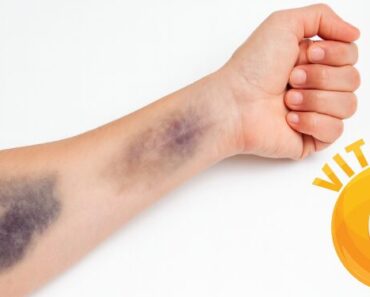 Your Body Might Be Low in Vitamin C – Here Are 9 Subtle Warnings You Shouldn’t Ignore